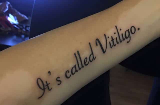 femme-vitiligo-tatouer.jpg