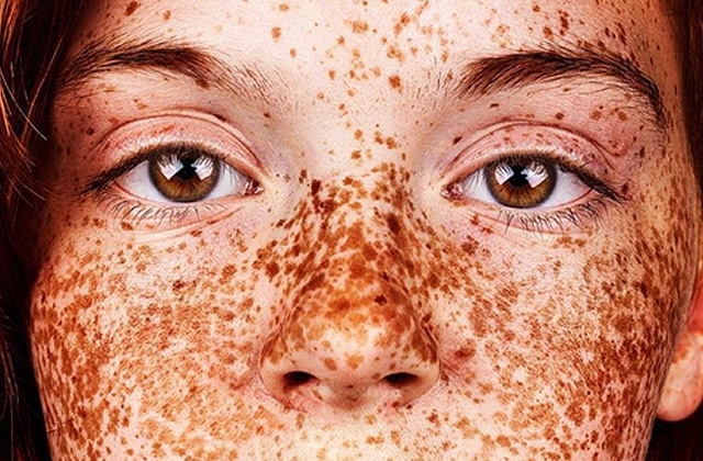 Le bronzage dans la tache de rousseur
