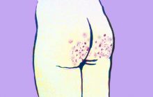 Comment se débarrasser de l’acné sur les fesses ?