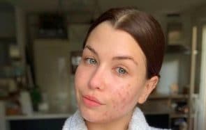 L’acné, un combat quotidien aussi pour EnjoyPhoenix