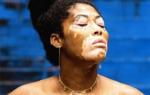 3 jeunes femmes racontent leur vie avec le vitiligo
