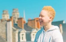 Je suis albinos et j’ai appris à vivre avec le regard des autres
