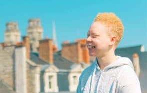 Je suis albinos et j’ai appris à vivre avec le regard des autres